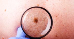 Καρκίνος του δέρματος: Πρόληψη και προστασία