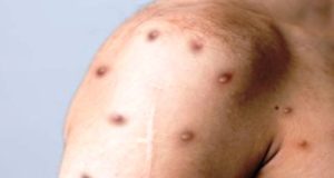 Πρόσθετες δόσεις εμβολίων για την ευλογιά των πιθήκων