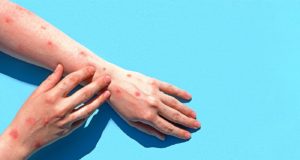 Ευλογιά των πιθήκων: Επιβιώνει πάνω σε επιφάνειες; Όσα γνωρίζουμε μέχρι στιγμής