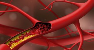 Πόσο καλά γνωρίζετε τη χοληστερόλη;