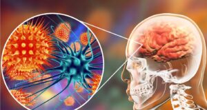 Τι είναι η κεραυνοβόλος μηνιγγίτιδα που οδηγεί και σε θάνατο