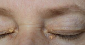 Σημάδια υψηλής χοληστερόλης: Μπορεί να εντοπιστεί μέσω των ματιών;