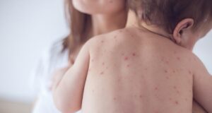 Αλυσίδα κρουσμάτων – Οκτώ παιδιά και μία νηπιαγωγός με ιλαρά – Οδηγίες από το Υπουργείο Υγείας