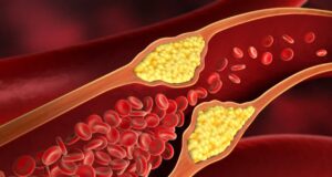 3 τρόποι για να μειώσετε τη χοληστερόλη με τη διατροφή – Ο πρώτος είναι ο λεγόμενος «χρυσός κανόνας»