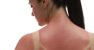 Κάτσατε πολύ ώρα στον ήλιο και πάθατε έγκαυμα; Να πώς θα το κρύψετε και θα απαλλαγείτε γρήγορα από αυτό