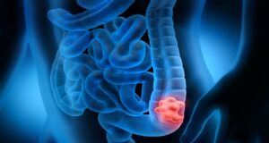 Καρκίνος παχέος εντέρου: Το ισχυρό αντιοξειδωτικό που αφθονεί στα κόκκινα σταφύλια και υπόσχεται θεραπεία