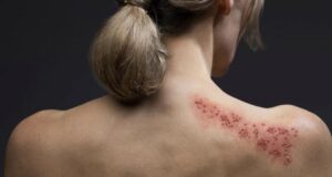 ΕΡΕΥΝΑ: Oι περισσότεροι ενήλικες στην Κύπρο δεν γνωρίζουν ότι 1 στους 3 θα αναπτύξει έρπητα ζωστήρα