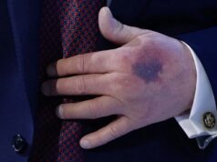 Ο μώλωπας στο χέρι Τραμπ που προκαλεί ψιθύρους – Η απάντηση που έδωσε