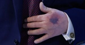 Ο μώλωπας στο χέρι Τραμπ που προκαλεί ψιθύρους – Η απάντηση που έδωσε