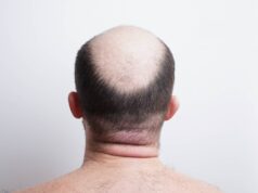 Τέλος η φαλάκρα; Νέος φυτικός ορός από την Κίνα συνδέεται με επανεμφάνιση μαλλιών μέσα σε λίγες εβδομάδες