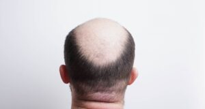 Τέλος η φαλάκρα; Νέος φυτικός ορός από την Κίνα συνδέεται με επανεμφάνιση μαλλιών μέσα σε λίγες εβδομάδες