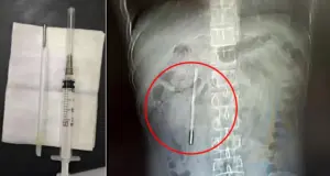 Άνδρας ζούσε επί 20 χρόνια με ένα… θερμόμετρο στο σώμα του, το αφαίρεσε μετά από έντονους πόνους στο στομάχι